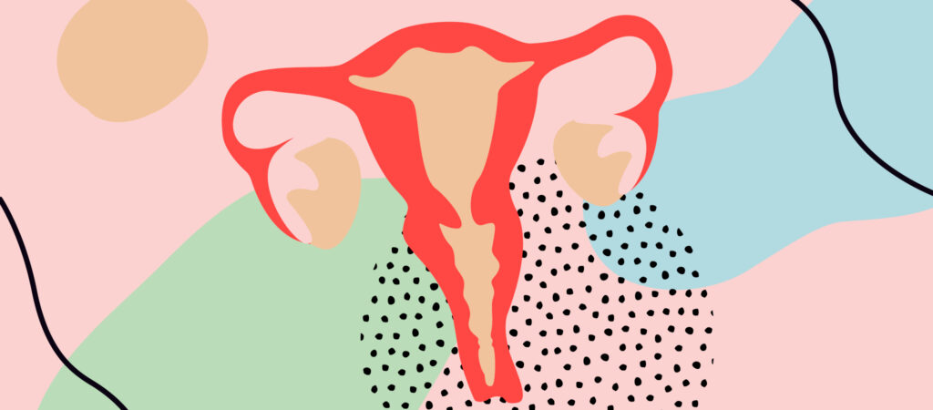 Imagen de endometriosis, fertilidad y anticonceptivo