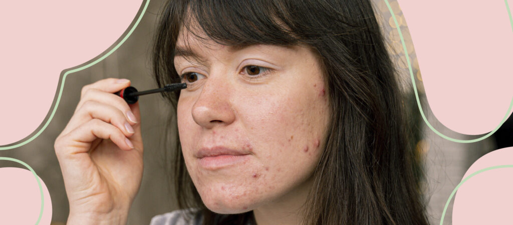 ¿Es normal el acné en adultos? Imagen