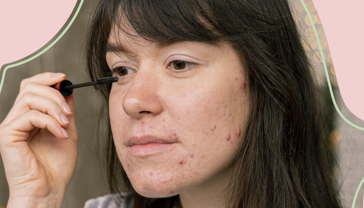 Is Adult Acne Normal?