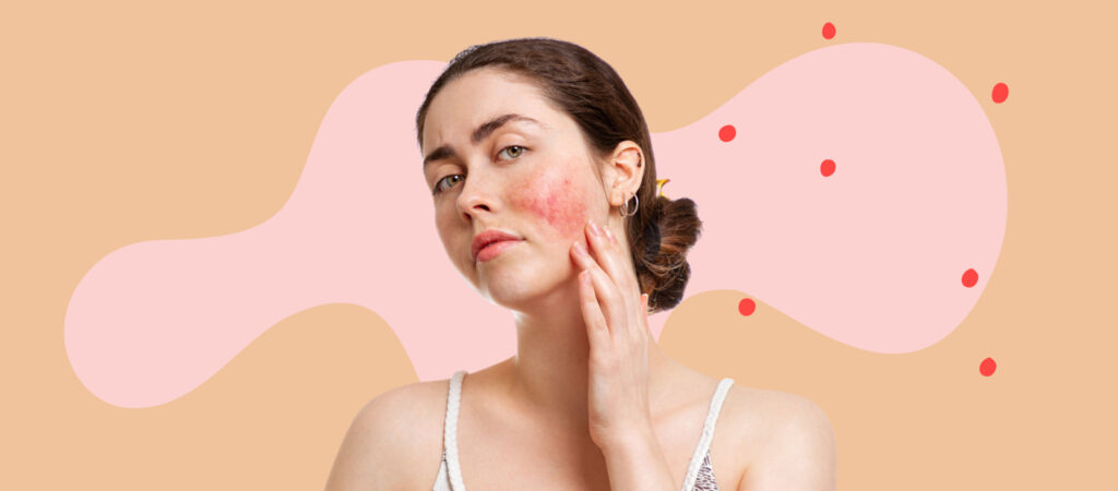 Rosacea and Makeup: What You Need to Know Image