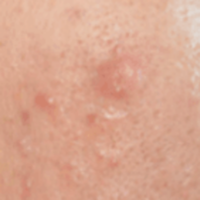 Image of Keloid scars