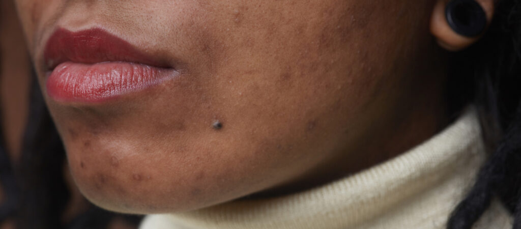 Guide to Melasma: Diagnosis, Treatment and Prevention Image