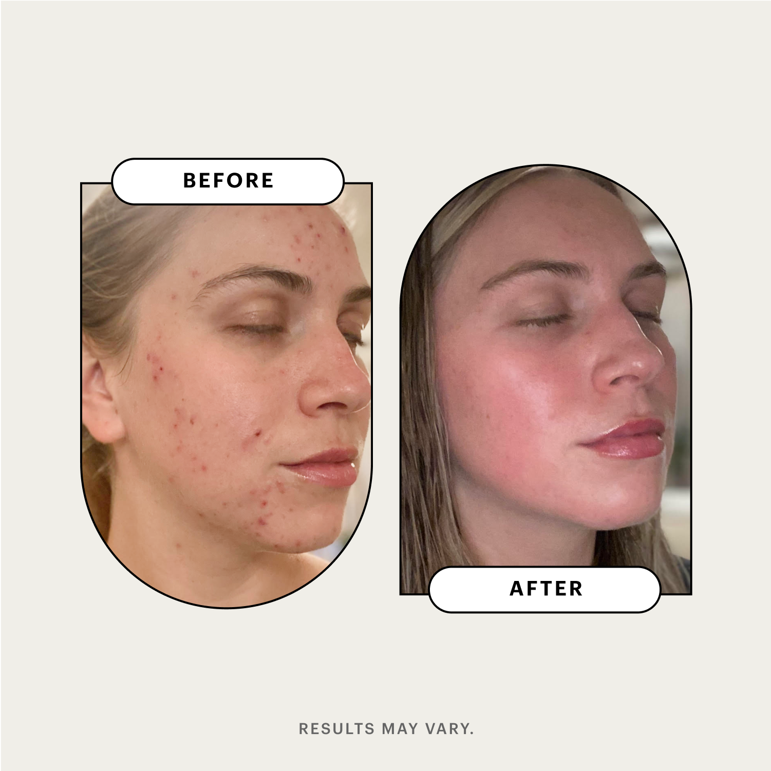 Clindamycin Phosphate Solution 1.0% (Cleocin) Acne Treatment Delivery Options, Uses, and Side Effects image photo